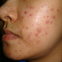 Acne Prevention What To Do And Not To Do